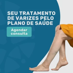 Tratamento de Varizes pelo plano de saúde Omint