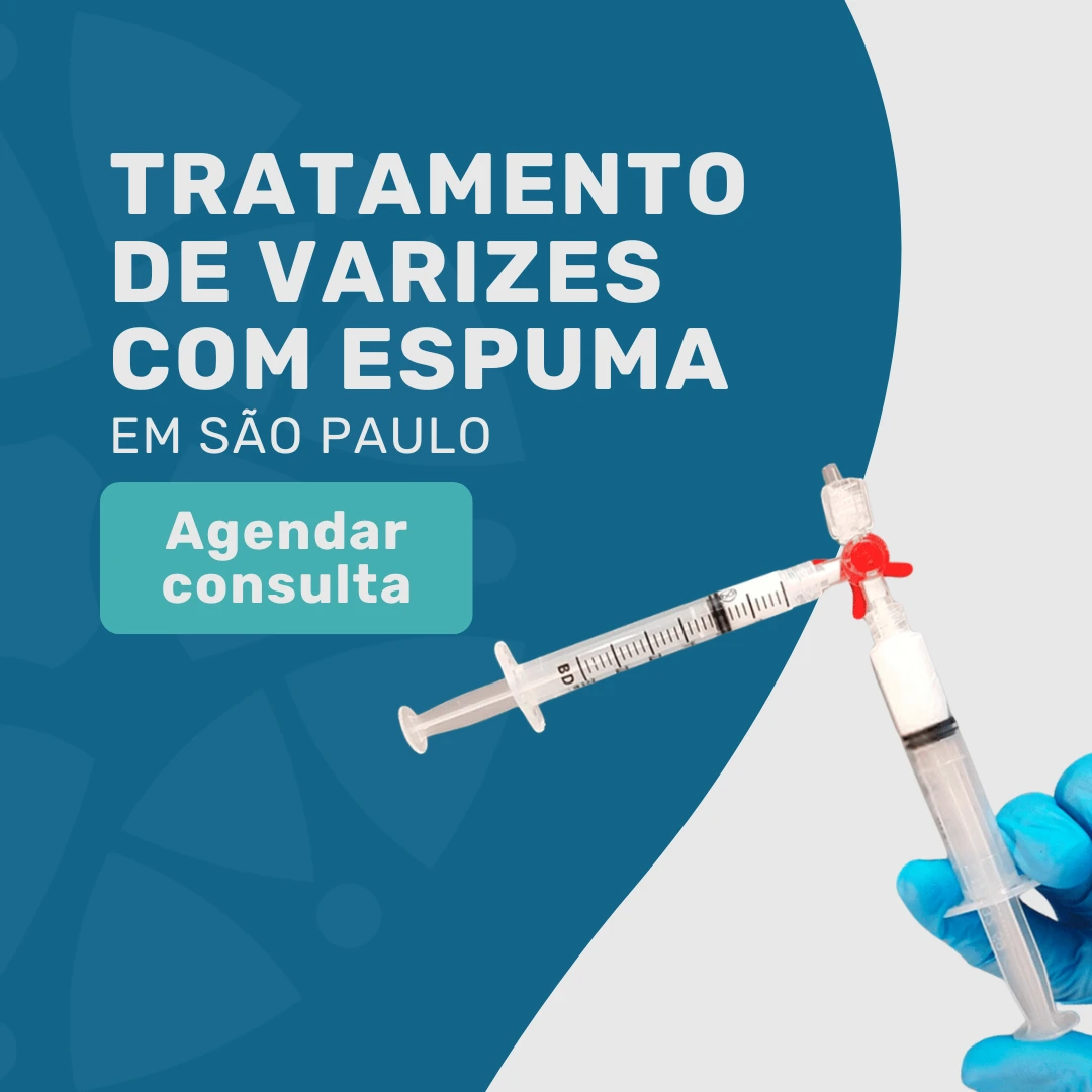 MEF- Guia do tratamento de varizes usando Escleroterapia com Espuma pelo Bradesco Saúde 