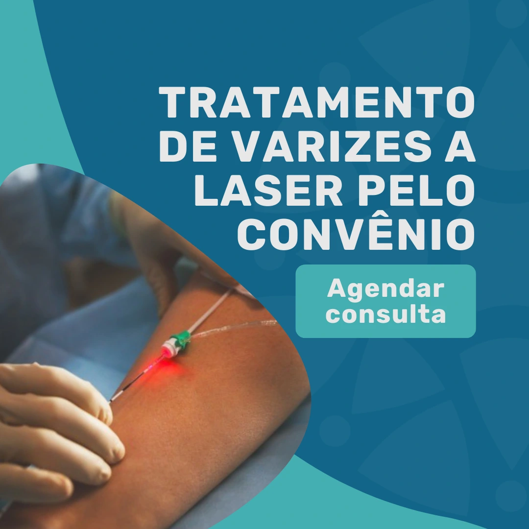 Tratamento de varizes a laser pelo convênio Bradesco Saúde na Medicina em Foco